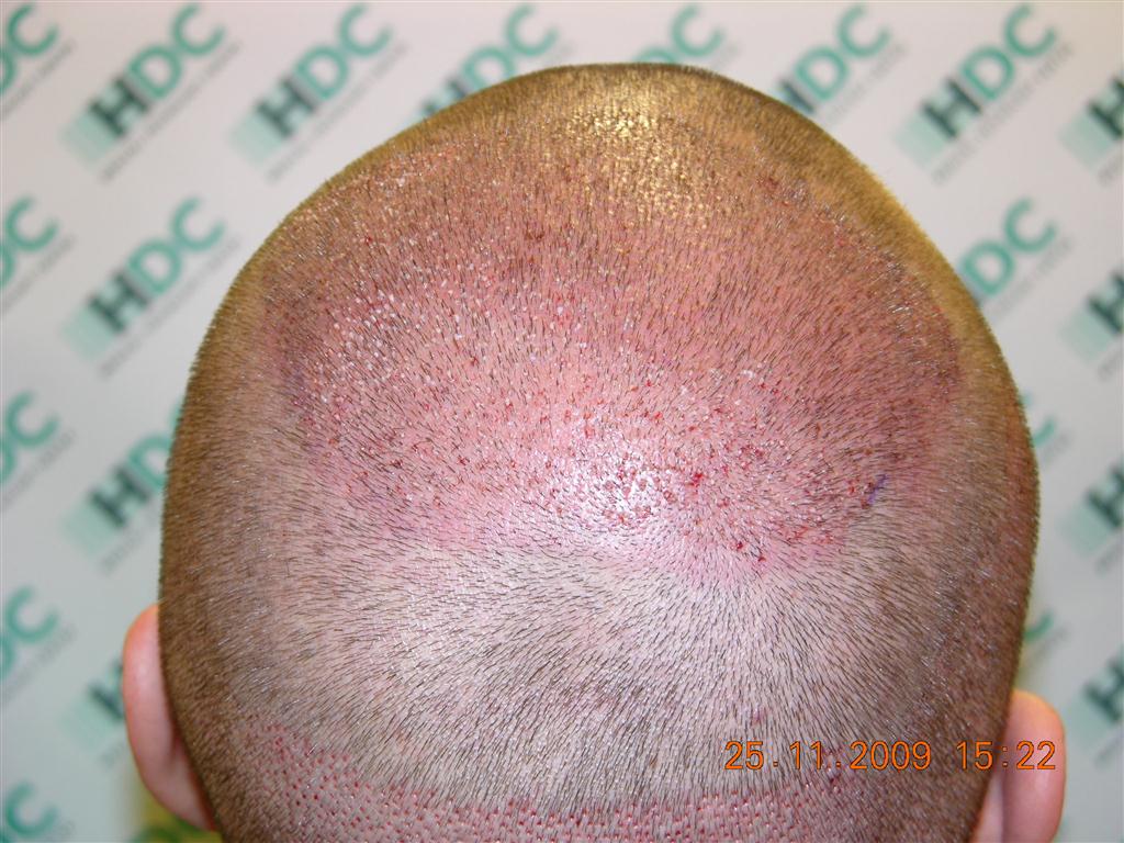 HDC Medical Chypre 3119 FUE International Hair Loss Forum hdc-medical-chypre-3119-fue-international-hair-loss-forum